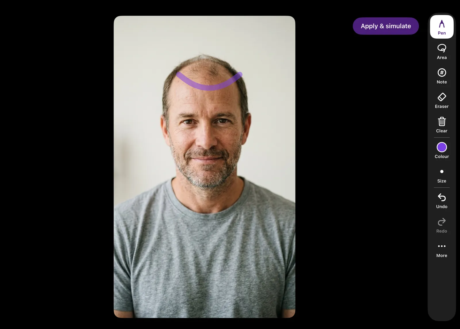 HairDraw 스케치 화면: 의사가 가상 환자의 사진 위에 계획한 헤어라인을 그리는 모습.